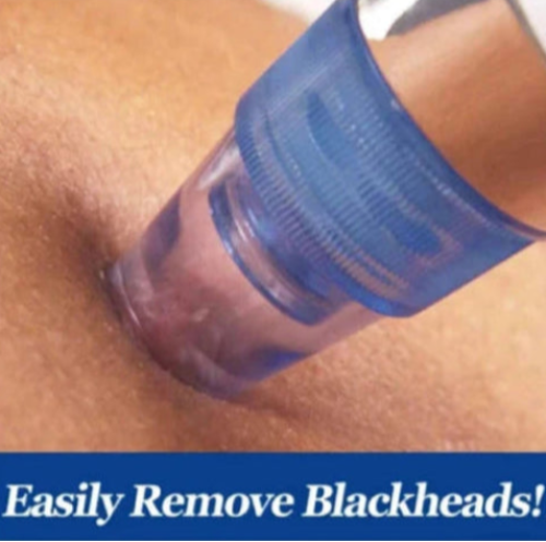 Pore vacuum tool removing blackheads from oily skin