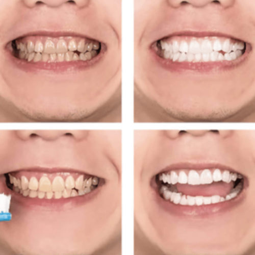 Gentle whitening mousse for sensitive teeth and gums