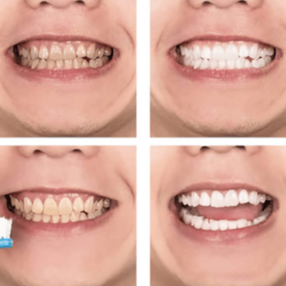 Gentle whitening mousse for sensitive teeth and gums