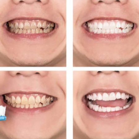 Teeth Whitening Mousse – Gentle Foam for a Brighter Smile